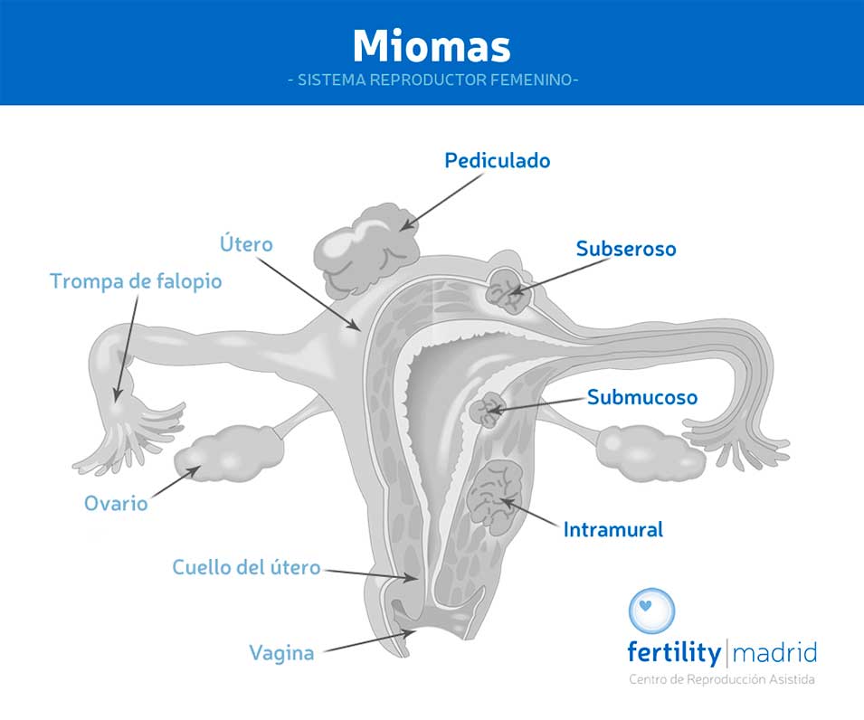 infografia-tipo-miomas-uterino